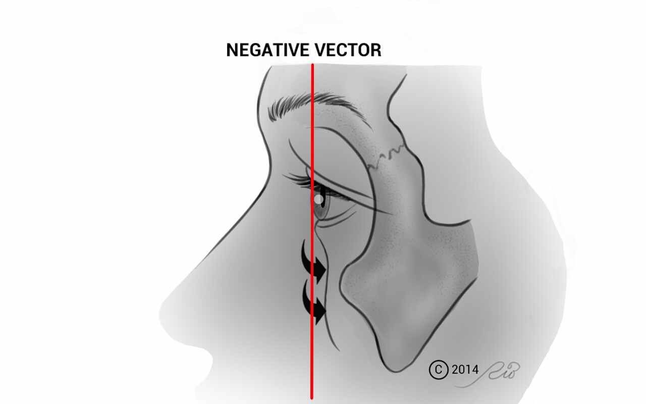 Negative Vector Eye Surgery