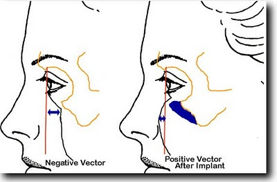 Under Eye Bags Tear Trough Deformity