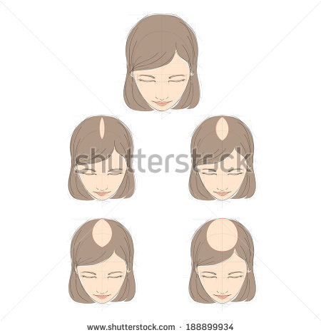 Female Hair Loss