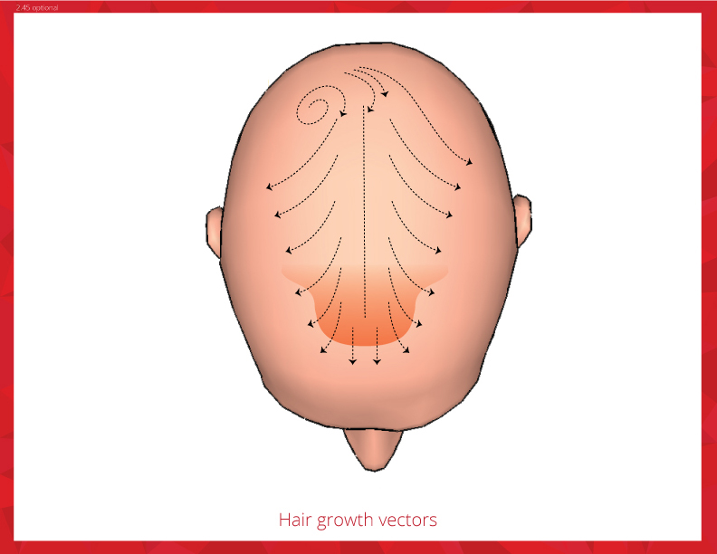 Hair Transplant Techniques