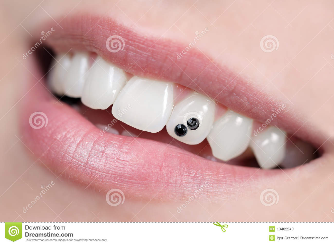 Tooth Enamel Erosion Tooth Enamel Erosion
