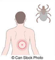 Lyme Disease Clip Art